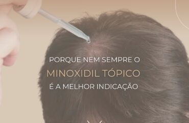 Por que Nem Sempre o Minoxidil Tópico é a Melhor Opção?