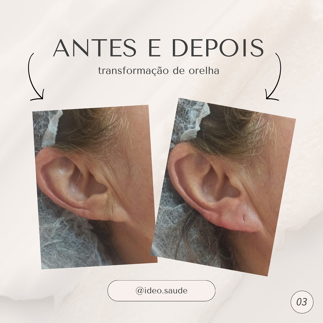 Antes e depois: transformação de orelha - Ideo Saúde