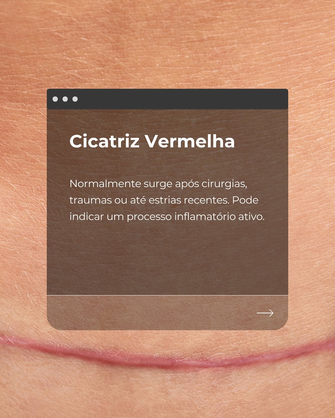 Tipos de cicatrizes: Você sabe qual é a sua? - Ideo Saúde